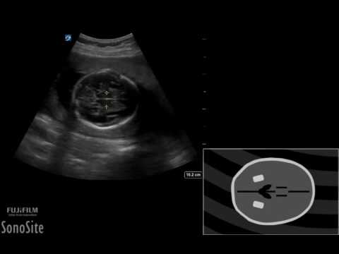 How To: Pregnancy BPD HC AC and FL Measurements 3D Video