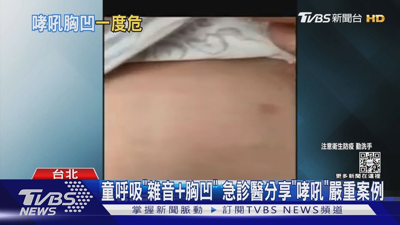 童呼吸「雜音+胸凹」 急診醫分享「哮吼」嚴重案例