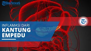 Kolesistitis, Inflamasi dari Kantung Empedu