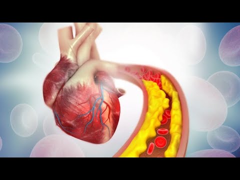 Sanningen om kolesterol, hur farligt är det egentligen?