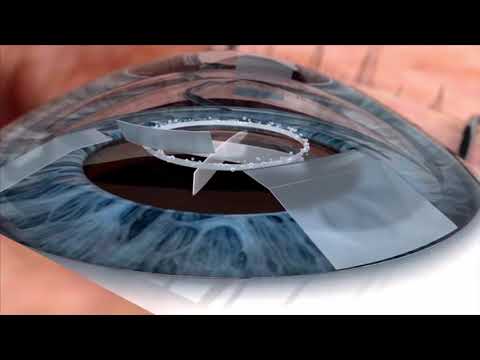 Watch live surgery using the laser cataract system - how does it work? Eye News TV