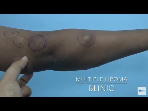 Patient Recovery Case — Video 3 (Gynecomastia)