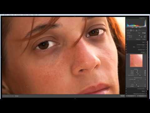 Togliere locchio hypostasis dopo un pungiglione di una zanzara Le ragioni di hypostasis di occhi a donne