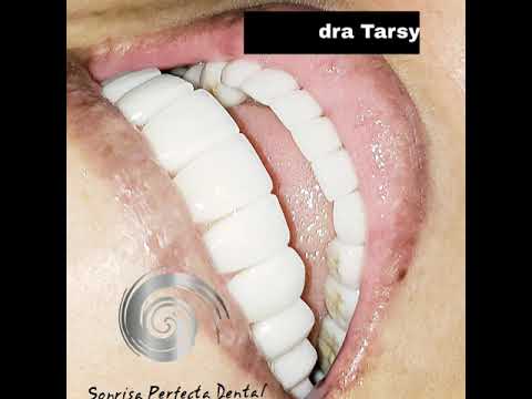 Smile Design in Cartagena, Colombia by dentist Tarsys Loayza
