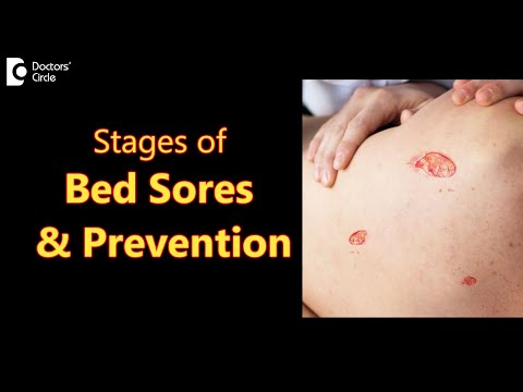 BED SORES (DECUBITUS ULCERS): Stages, Causes, Symptoms & Treatment-Dr.Aruna Prasad | Doctors' Circle