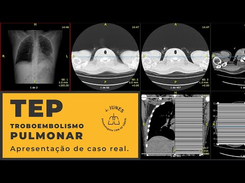 CASO REAL. Tromboembolismo Pulmonar (TEP). Apresentação de um caso real.