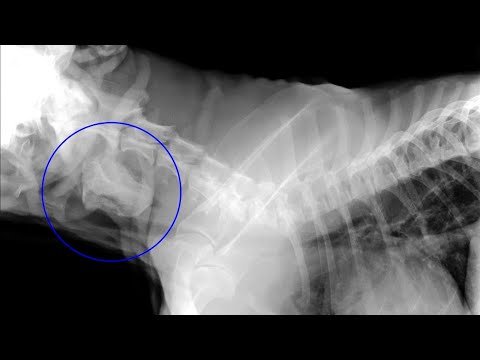 Foreign body removed from the esophagus avoiding surgery.