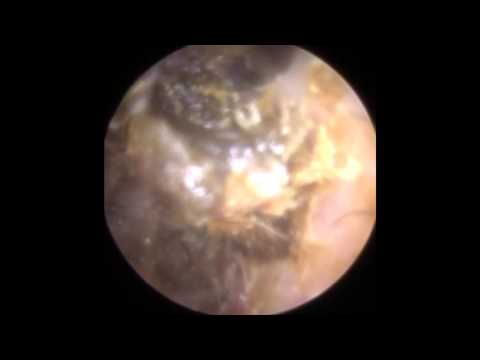 Ear Wax Removal using E-suction®, Ear Hook, Jobson Horne & Drops in Narrowed Ear  - The Hear Clinic