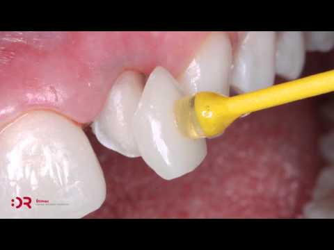 Ljuskice za zube u Hrvatskoj | Stomatološka poliklinika Zagreb | Štimac centar dentalne medicine