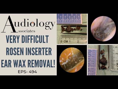 VERY DIFFICULT ROSEN INSERTER EAR WAX REMOVAL - EP494