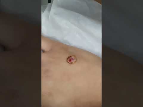 Can Doctors Remove Warts in Just One Session?聽
