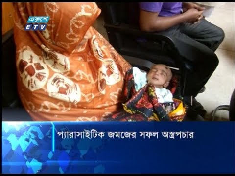 প্যারাসাইটিক জমজের সফল অস্ত্রপচার