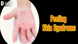 Peeling Skin Syndrome: Causes, Symptoms & Treatment | Peeling Skin - Dr. Nischal K | Doctors