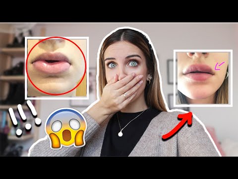 😰ME DEFORMARON LOS LABIOS 🆘 MI EXPERIENCIA CON EL ÁCIDO HIALURÓNICO💥