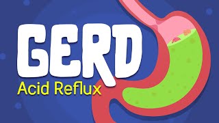 Why is your Stomach Burning? - Acid Reflux || GERD Treatment and symptoms