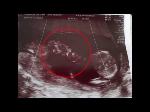 Binjakët shpëtuan njëri-tjetrin duke u përqafuar në bark