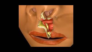 Classic Millard Cleft Lip Repair