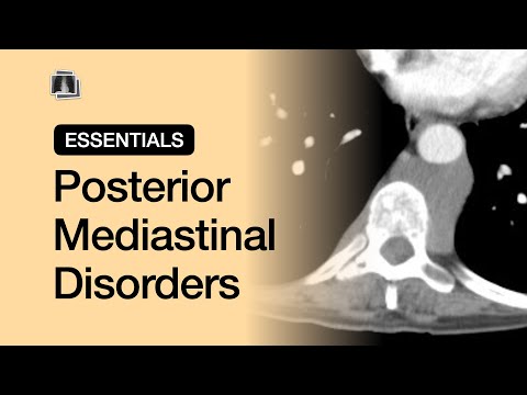 Posterior Mediastinal Disorders | Chest Radiology Essentials