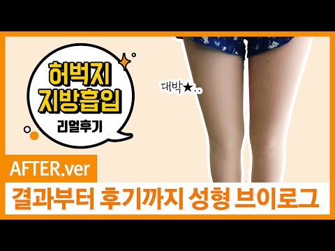 허벅지 지방흡입 브이로그, 2편 지방흡입 그 이후 변화는?