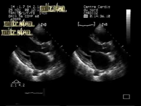 Rheumatic Heart Disease With Mild Mitral Leaflets Fibrosis Without Significant Stenosis