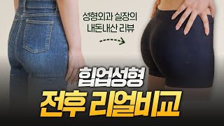 타병원 성형외과 실장이 직접 경험한 힙 지방이식 후기