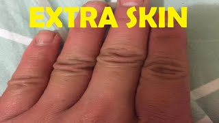 how to get rid of extra skin on fingers