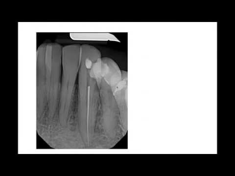 Broken Instrument Removal