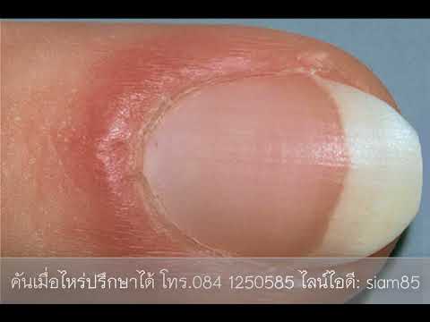 กลากบนใบหน้าของผู้หญิง อาการโรคสะเก็ดเงินในฟุต