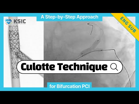[SUB]Culotte Technique for Bifurcation PCI: A Step-by-Step Approach