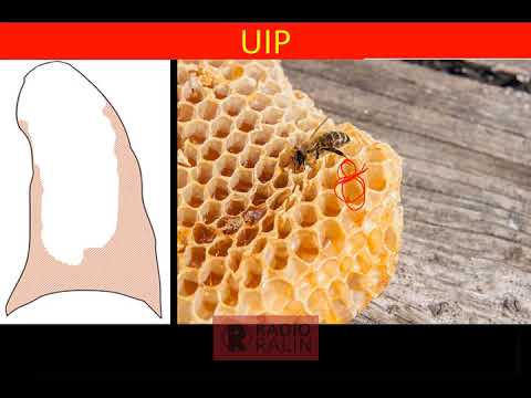 INTERSTITIAL LUNG DISEASE HRCT PATTERNS