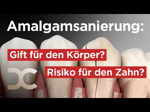 Amalgamfüllung austauschen oder nicht? Interview mit Dr. Kass | Dorow Clinic