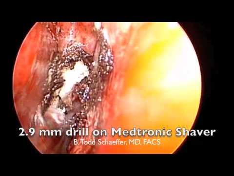 Correction of Choanal Atresia