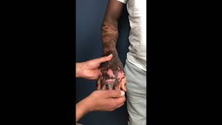 Joe's Journey: Bilateral Burnt Hands Pre Op Assessment