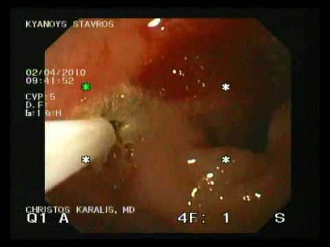 Sangrado del bulbo duodenal - laseroterapia