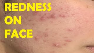 how to get rid of redness on face after popping pimples