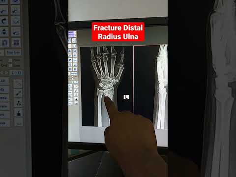 Fracture Radius Ulna | X-ray Wrist #shorts #radiography #xray