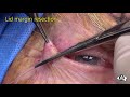 Bick Eyelid Margin Resection