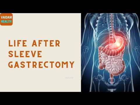 Life After Sleeve Gastrectomy