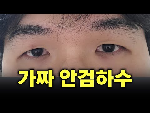 上睑下垂 02
