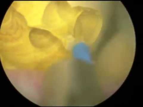 Rimozione del laser di BPH a Mosca La chemioterapia di adenoma prostatico