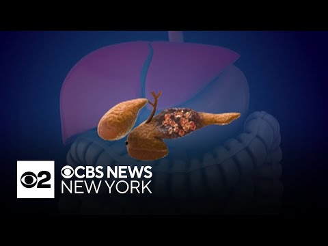 A.I. tool could help detect deadly pancreatic cancer, Mayo ...