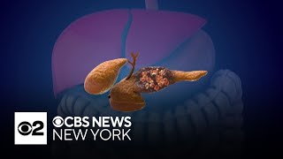 A.I. tool could help detect deadly pancreatic cancer, Mayo Clinic says