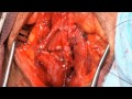 Anastomotic augmented urethroplasty with buccal ...