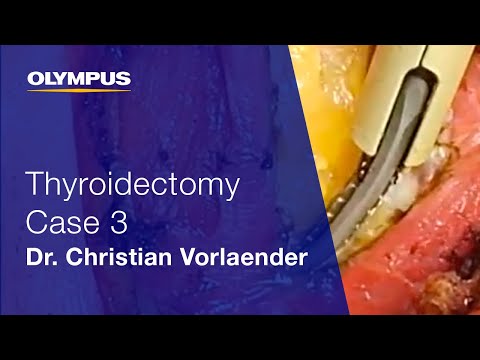Total Thyroidectomy | THUNDERBEAT | Dr. Christian Vorlaender | Case 3