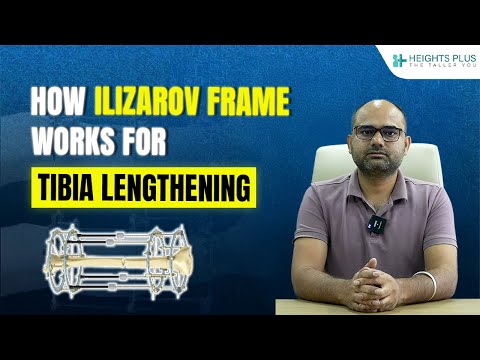 How Ilizarov Frame Works For Tibia Lengthening Explained by Navish Kumar