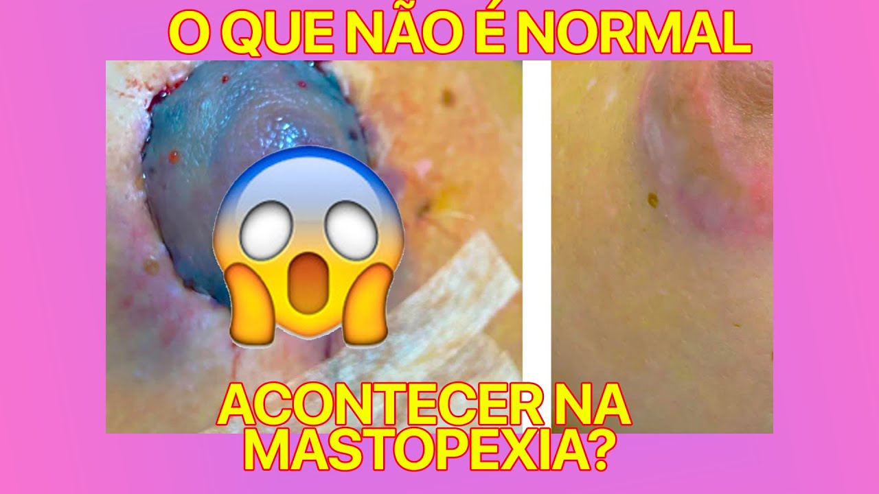 O QUE NÃO É NORMAL DE ACONTECER APÓS A MASTOPEXIA? CIRURGIA PLÁSTICA