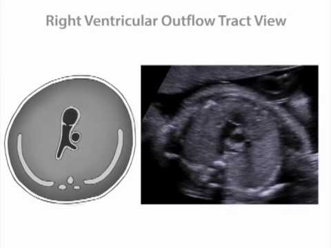 Right Ventricular Outflow Tract View of the Fetal Heart