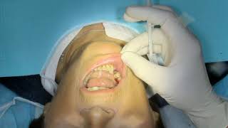 comblement d'alvéole d'extraction par matériau allogénique ( anesthésie seringue quick sleeper)