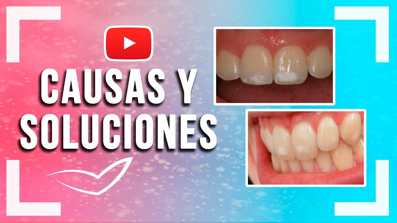 Watch Manchas Blancas en los Dientes l Fluorosis Dental y otras causas y soluciones Now Manchas Blancas en los Dientes l Fluorosis Dental y otras causas y soluciones