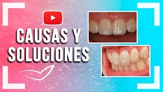 Manchas Blancas en los Dientes l Fluorosis Dental y otras causas y soluciones